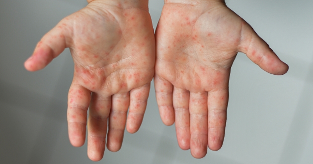 Manos con síntomas de sarampion, se observan puntos rojos en las palmas de las manos. 