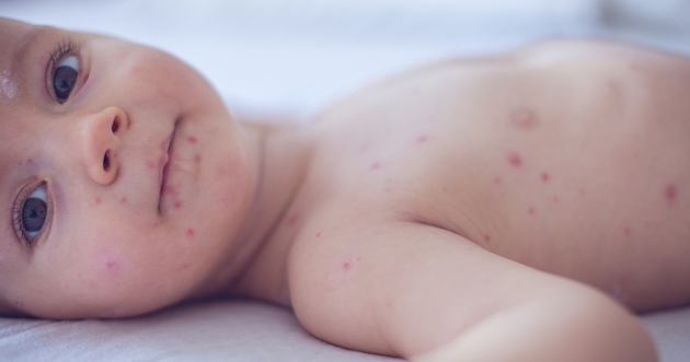 Bebé con síntomas de varicela